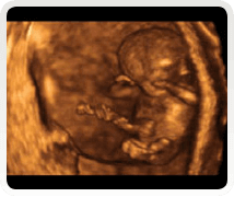 week 13 2d baby scan